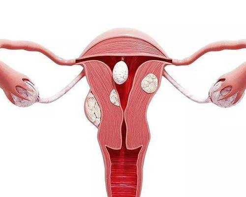 子宫肌瘤长在后壁严重吗，宫底后壁子宫肌瘤能做试管吗