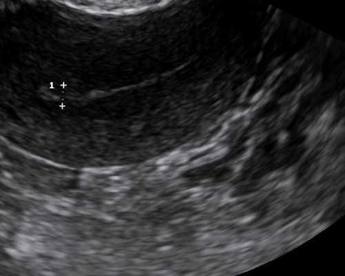 试管婴儿取卵一定要麻醉吗？麻醉取卵全过程
