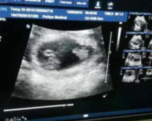 卵泡发育慢怎么办-国内代孕网电话