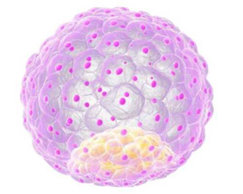 20岁女孩多囊卵巢怎么办