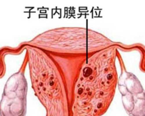 电视剧古玩虫演员表,子宫肌瘤开腹剔除术